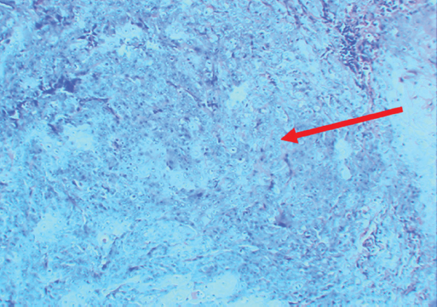 Photomicrograph of the excisional biopsy showing dysplastic epithelium proliferating into the connective tissue (red arrow) suggestive of papillary squamous cell carcinoma (H and E, ×40).